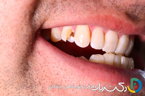 آیا عصب کشی برای دندان های آسیب دیده از ضربه مناسب است؟