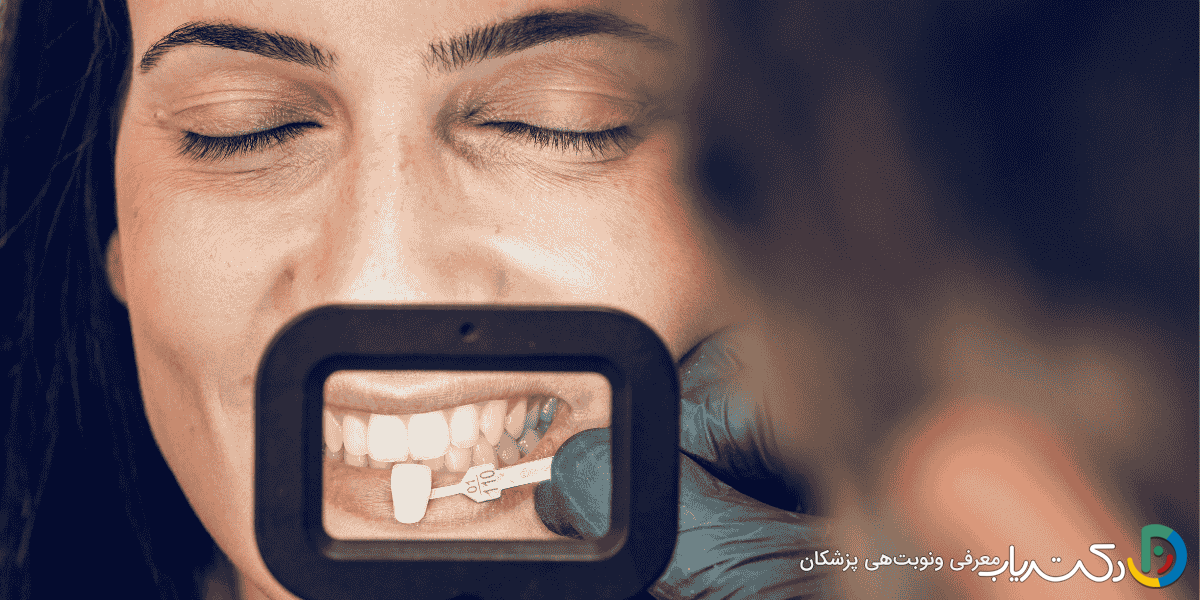 آیا بعد از انجام کامپوزیت دندان باید مراقبت خاصی انجام دهیم؟
