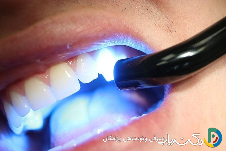 آیا کامپوزیت دندان درد دارد؟