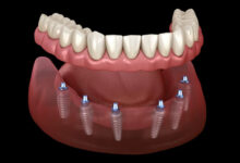 امکان ایمپلنت دندان برای افراد با کمبود استخوان