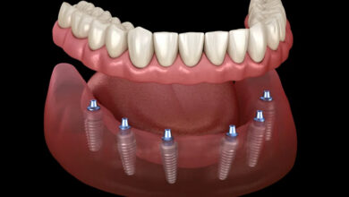امکان ایمپلنت دندان برای افراد با کمبود استخوان