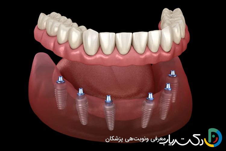 امکان ایمپلنت دندان برای افراد با کمبود استخوان