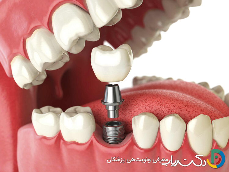 چرا ایمپلنت های دندان دیجیتال محبوب تر از ایمپلنت های سنتی هستند؟