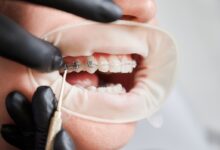 چگونه درمان ارتودنسی در افراد مسن با افراد جوان تفاوت دارد؟