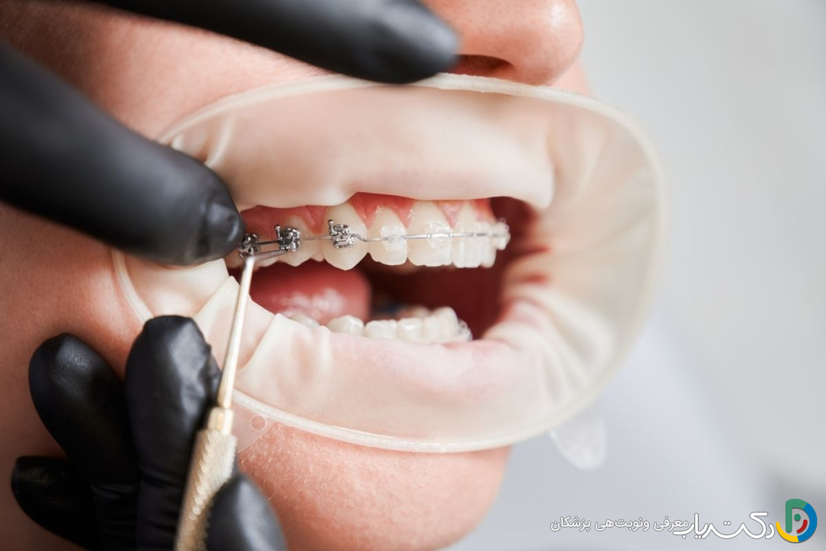 چگونه درمان ارتودنسی در افراد مسن با افراد جوان تفاوت دارد؟