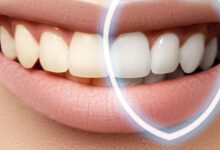 آیا بلیچینگ دندان نیاز به تکرار دارد؟