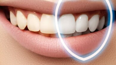 آیا بلیچینگ دندان نیاز به تکرار دارد؟