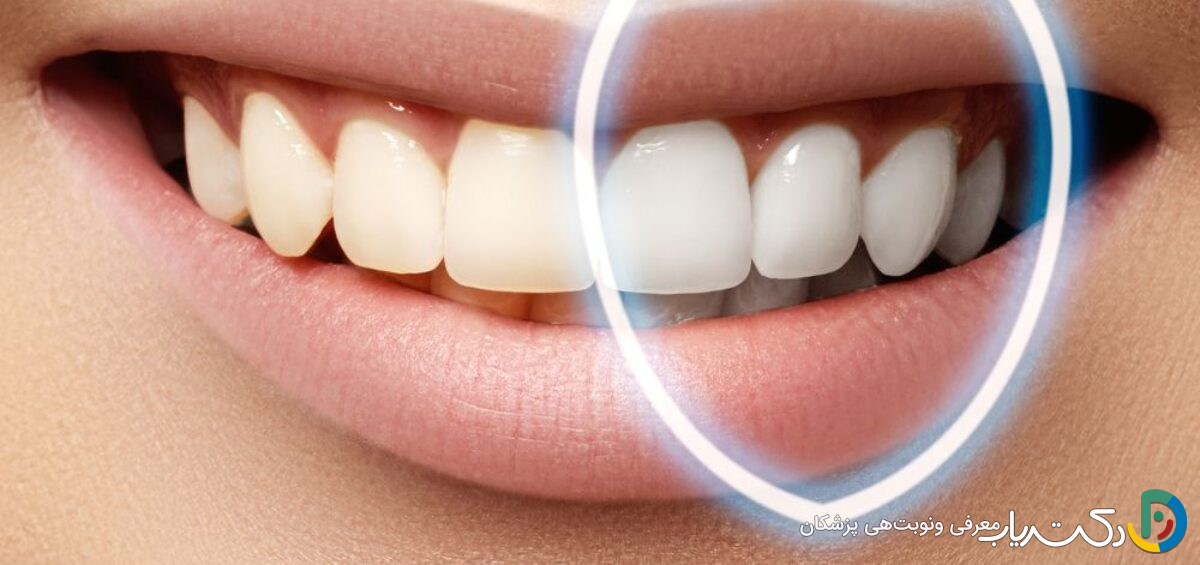 آیا بلیچینگ دندان نیاز به تکرار دارد؟