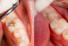 آیا تحقیقات جدید نشان می دهند که ترمیم دندان طول عمر بیشتری دارد؟