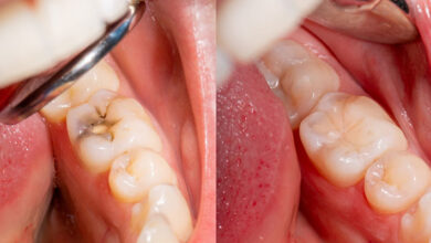 آیا تحقیقات جدید نشان می دهند که ترمیم دندان طول عمر بیشتری دارد؟