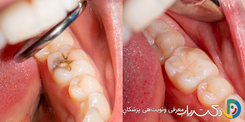 آیا تحقیقات جدید نشان می دهند که ترمیم دندان طول عمر بیشتری دارد؟