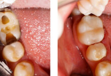 آیا ترمیم دندان باعث تغییر شکل دندان می شود؟