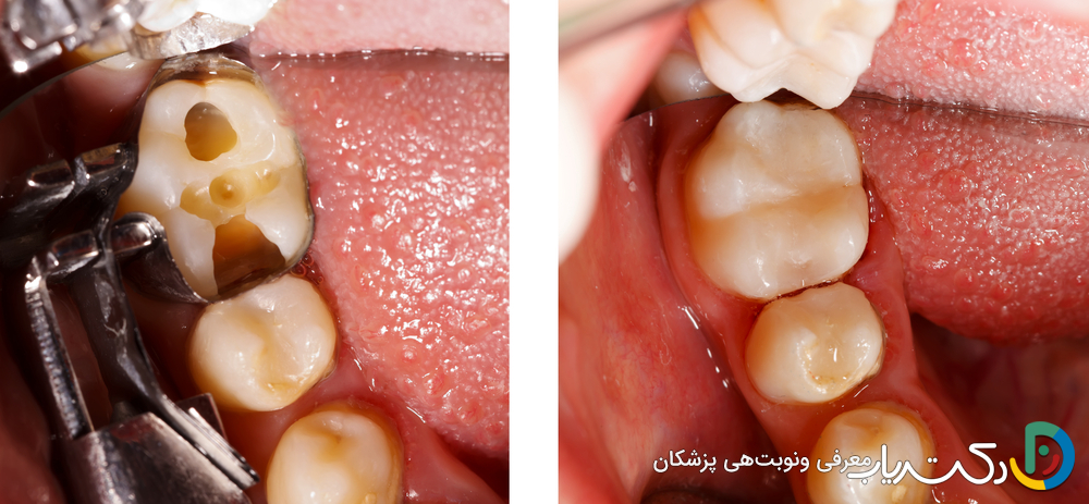 آیا ترمیم دندان باعث تغییر شکل دندان می شود؟