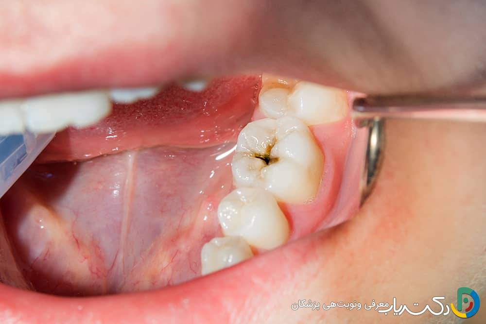 آیا ترمیم دندان باعث درد یا حساسیت می شود؟