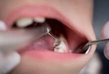آیا ترمیم دندان باید چندین بار تکرار شود؟