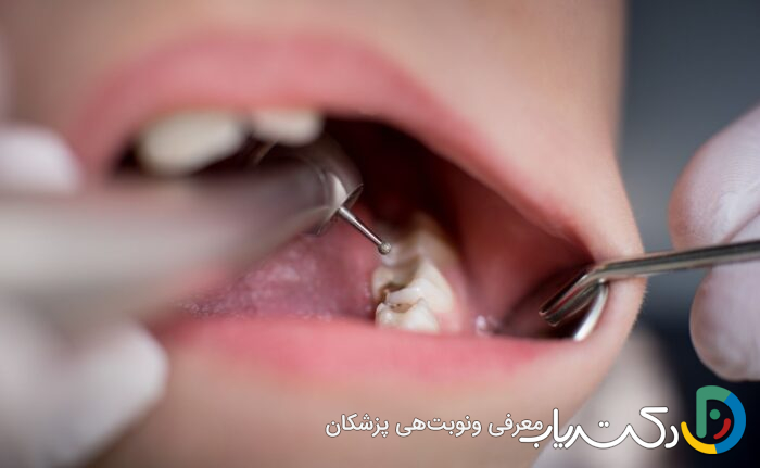 آیا ترمیم دندان باید چندین بار تکرار شود؟