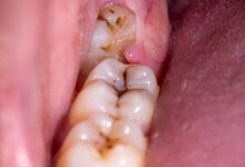 آبسه دندان عقل چه علائمی دارد و چگونه درمان میشود؟