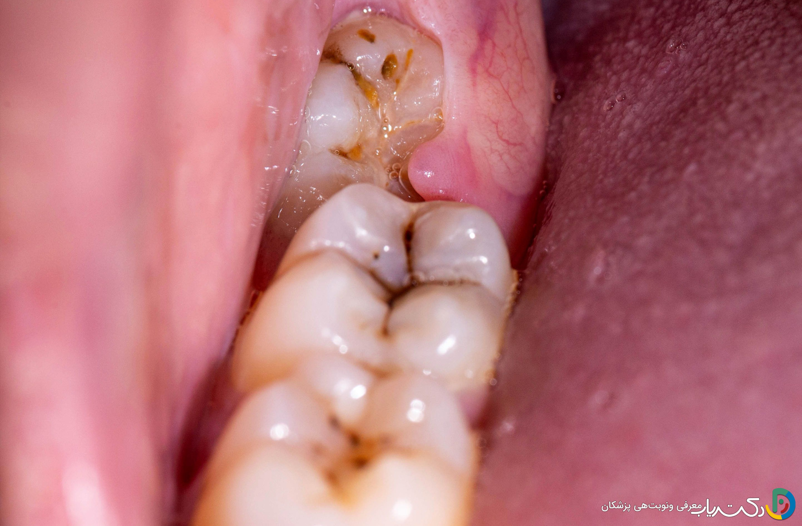 آبسه دندان عقل چه علائمی دارد و چگونه درمان میشود؟