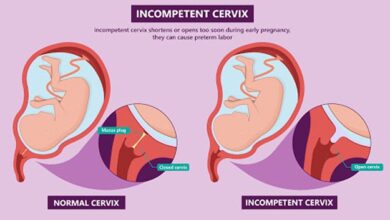 آیا بعد از یک بار سرکلاژ، در بارداریهای بعدی هم به آن نیاز دارم؟