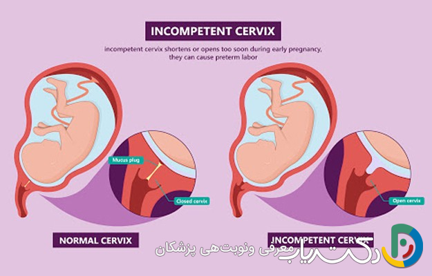 آیا بعد از یک بار سرکلاژ، در بارداریهای بعدی هم به آن نیاز دارم؟
