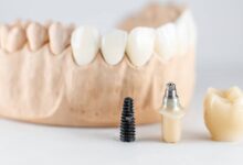 ایمپلنت کره ای بهتر است یا سوئیسی؟