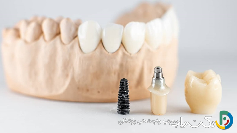 ایمپلنت کره ای بهتر است یا سوئیسی؟