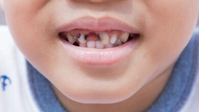 آیا لمینت دندان برای کودکان عوارض دارد؟