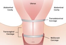 سرکلاژ در هفته چندم بارداری انجام میشود؟