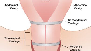 سرکلاژ در هفته چندم بارداری انجام میشود؟