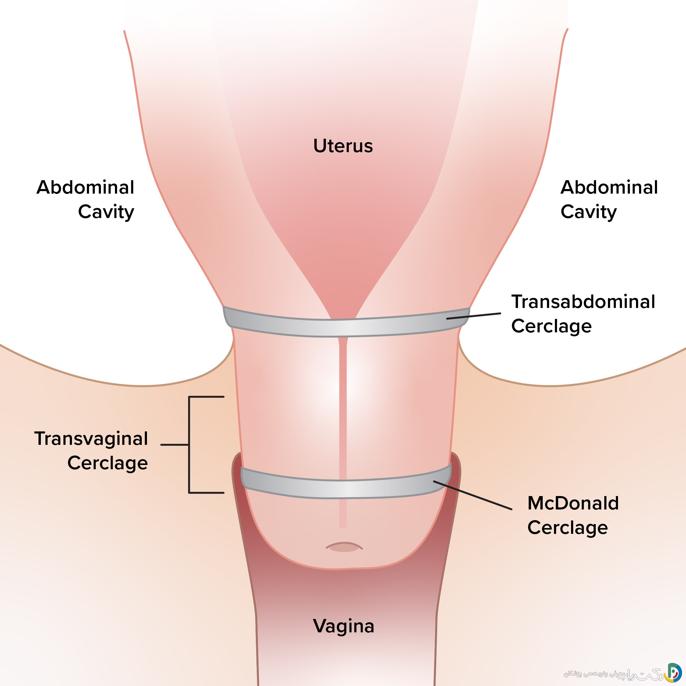 سرکلاژ در هفته چندم بارداری انجام میشود؟