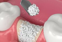 پیوند استخوان در ایمپلنت دندان