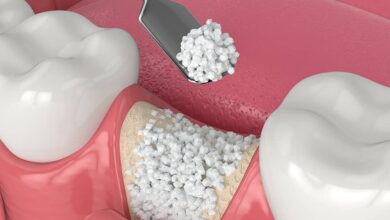 پیوند استخوان در ایمپلنت دندان