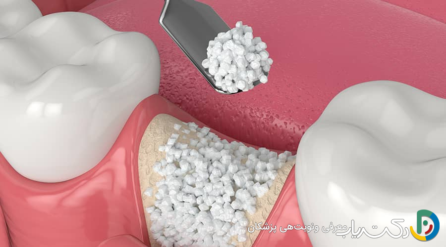 پیوند استخوان در ایمپلنت دندان