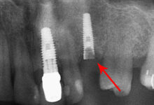 در صورت شکستن پیچ داخل ایمپلنت چه باید کرد؟