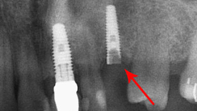 در صورت شکستن پیچ داخل ایمپلنت چه باید کرد؟