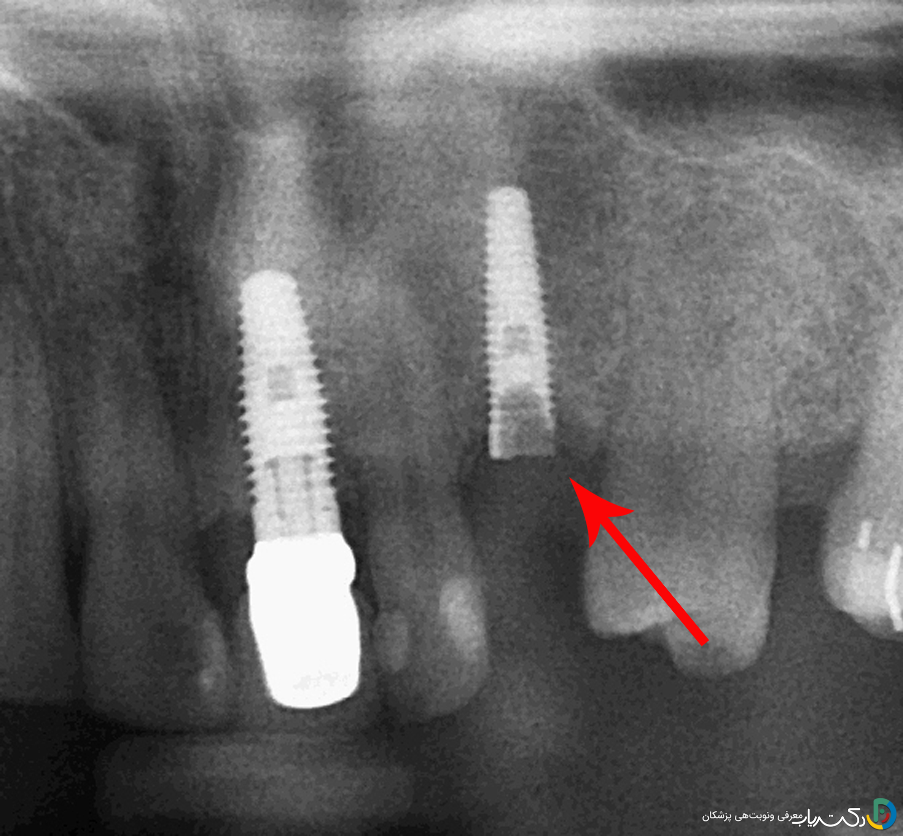 در صورت شکستن پیچ داخل ایمپلنت چه باید کرد؟