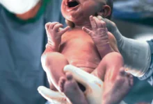 آیا با داشتن سرکلاژ می‌توان سزارین شد؟