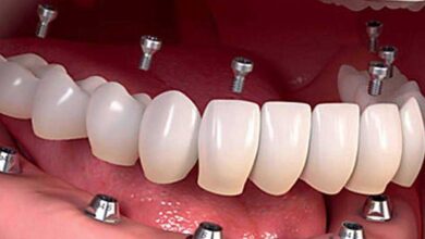 آیا می توان کل دندان های یک فک را با ایمپلنت جایگزین کرد؟