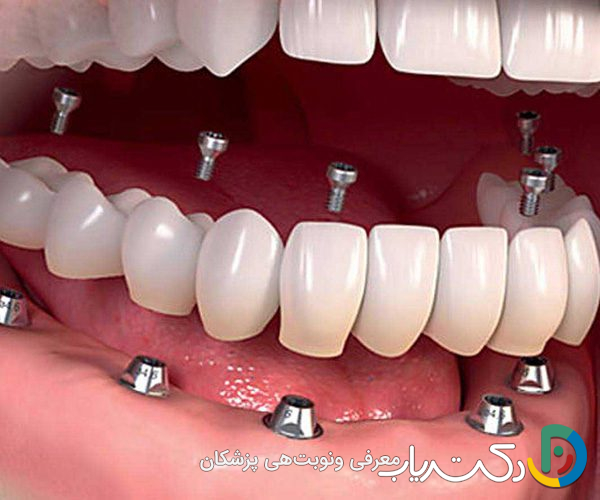 آیا می توان کل دندان های یک فک را با ایمپلنت جایگزین کرد؟