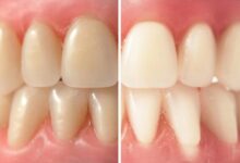 آیا می توان رنگ دندان مصنوعی را سفیدتر کرد؟