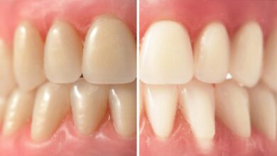 آیا می توان رنگ دندان مصنوعی را سفیدتر کرد؟