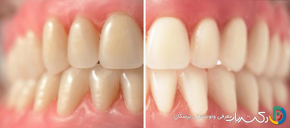 آیا می توان رنگ دندان مصنوعی را سفیدتر کرد؟