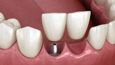 آیا می توان از یک ایمپلنت برای دو دندان استفاده کرد؟