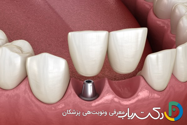 آیا می توان از یک ایمپلنت برای دو دندان استفاده کرد؟