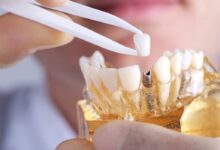 آیا می توان همزمان با ایمپلنت، ارتودنسی هم انجام داد؟