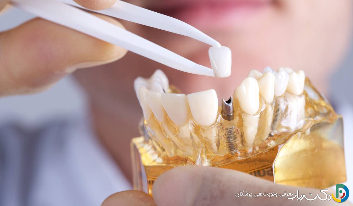 آیا می توان همزمان با ایمپلنت، ارتودنسی هم انجام داد؟