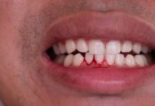 علت التهاب لثه بعد از کامپوزیت