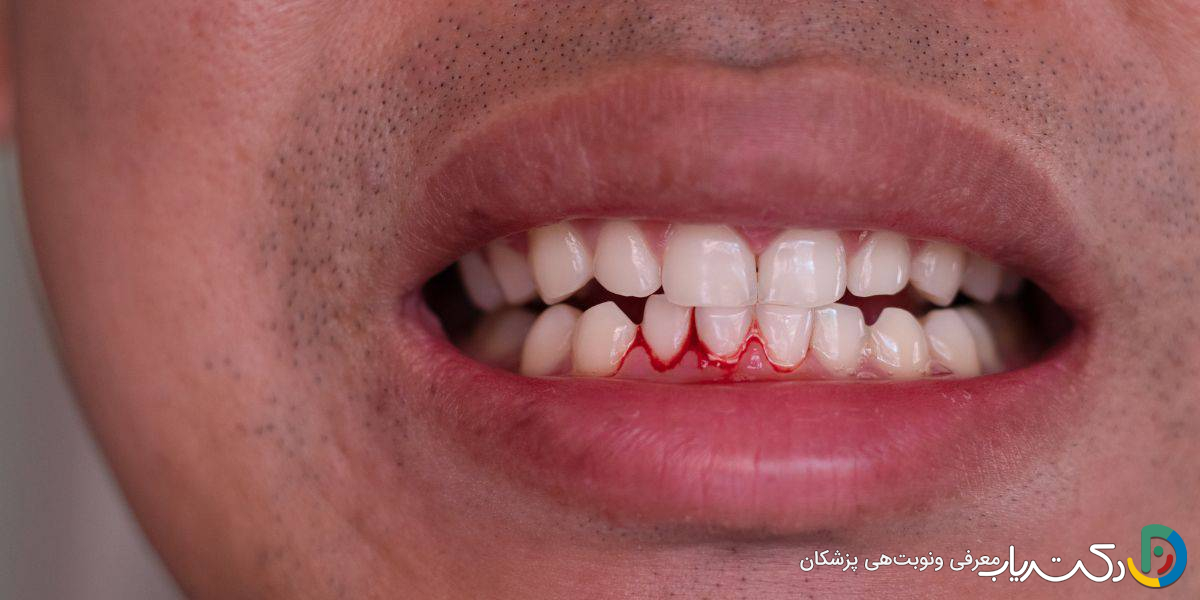 علت التهاب لثه بعد از کامپوزیت