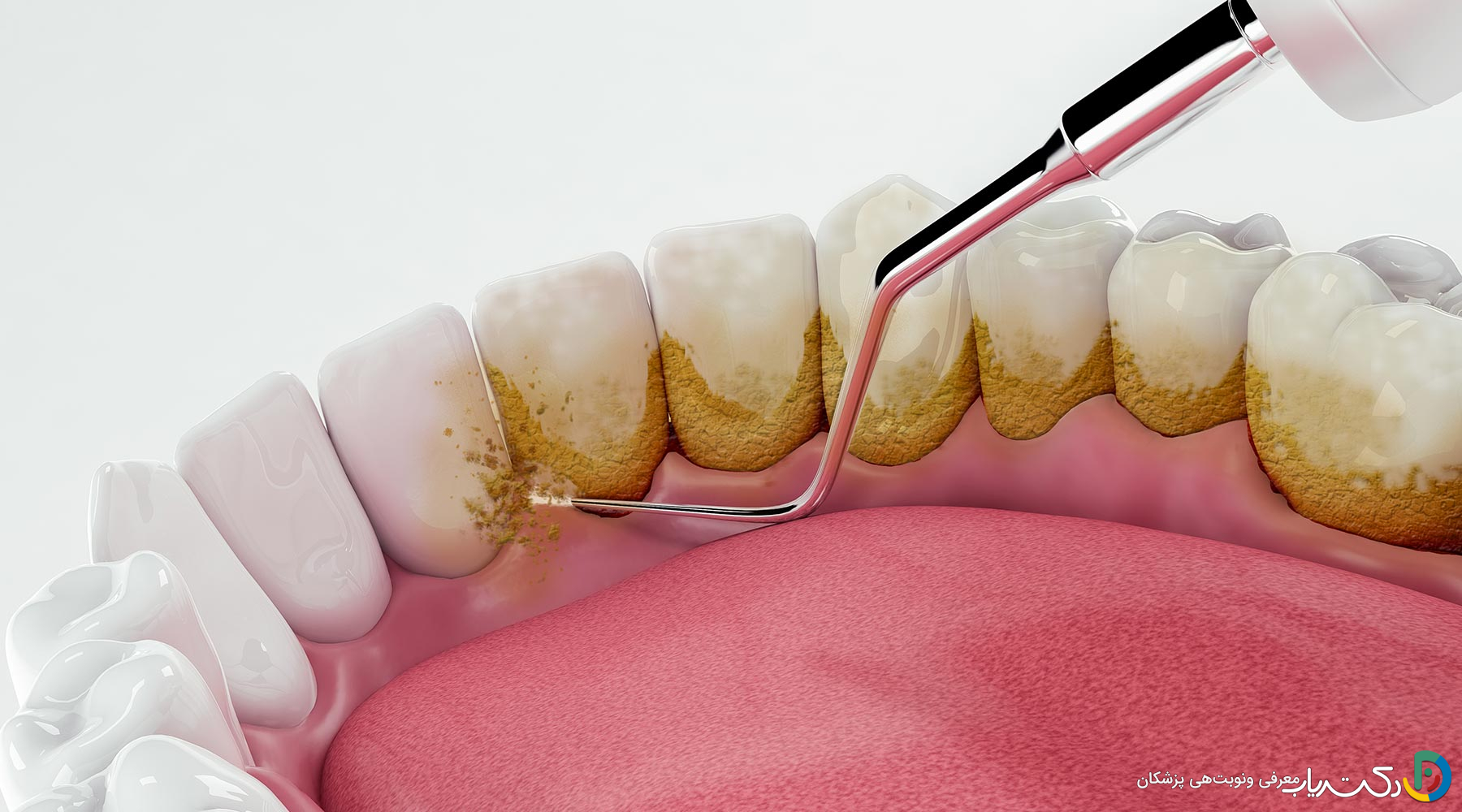 جرم گیری دندان و مراقبت های قبل و بعد از آن