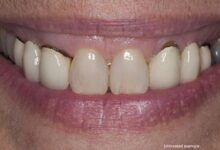 آیا روکش های PFM باعث سیاهی لثه می شوند؟